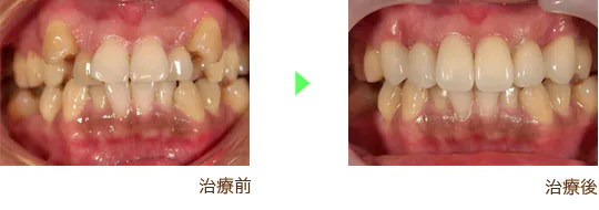審美歯科治療の治療例