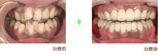 審美歯科治療の治療例