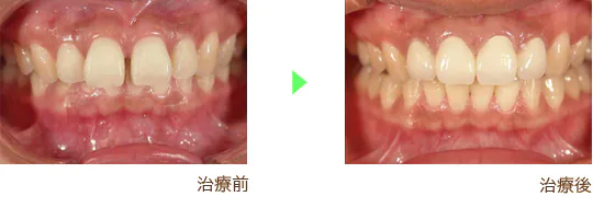 審美歯科治療の治療例