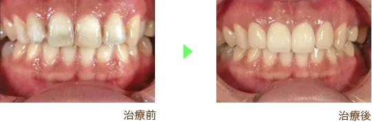 審美歯科治療の治療例