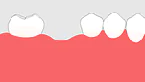 インプラントとブリッジや入れ歯との比較