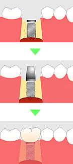 インプラントにした場合