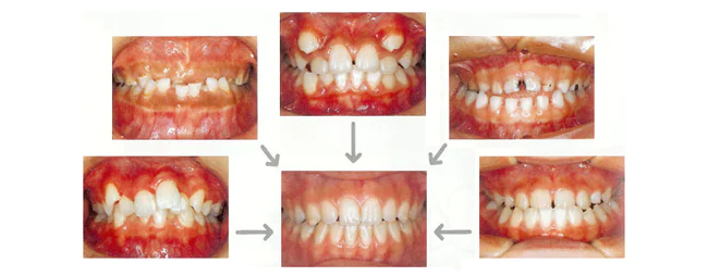 当クリニックの矯正治療