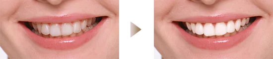 最短1日で終わるオフィスホワイトニング