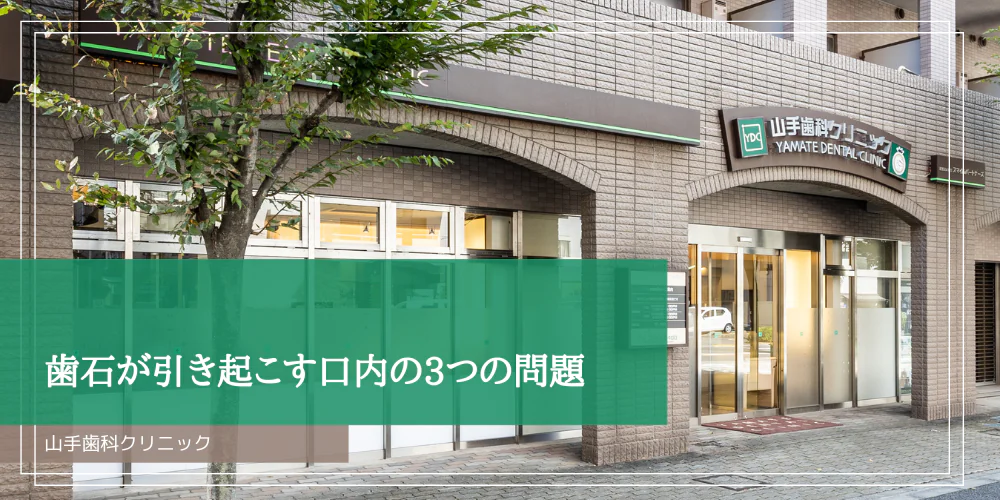 歯石が引き起こす口内の3つの問題