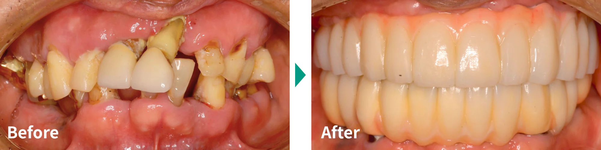 全顎インプラント治療症例写真02｜山手歯科クリニック大井町