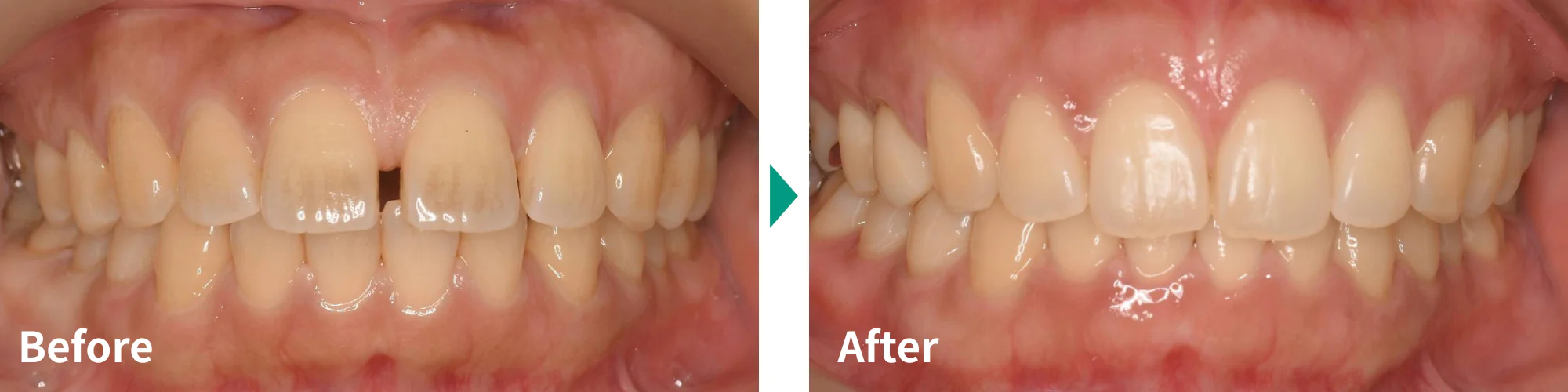 マウスピース矯正（インビザライン）症例写真01｜山手歯科クリニック大井町