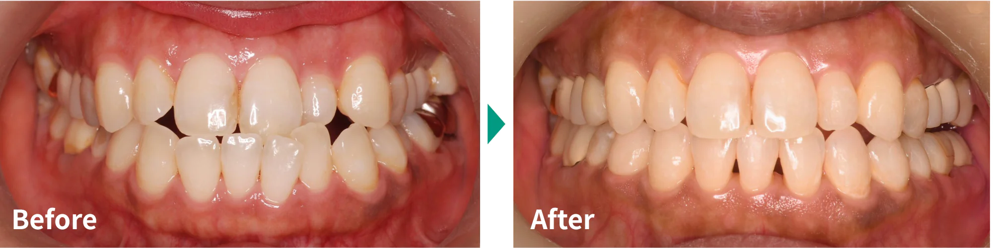 マウスピース矯正（インビザライン）症例写真02｜山手歯科クリニック大井町