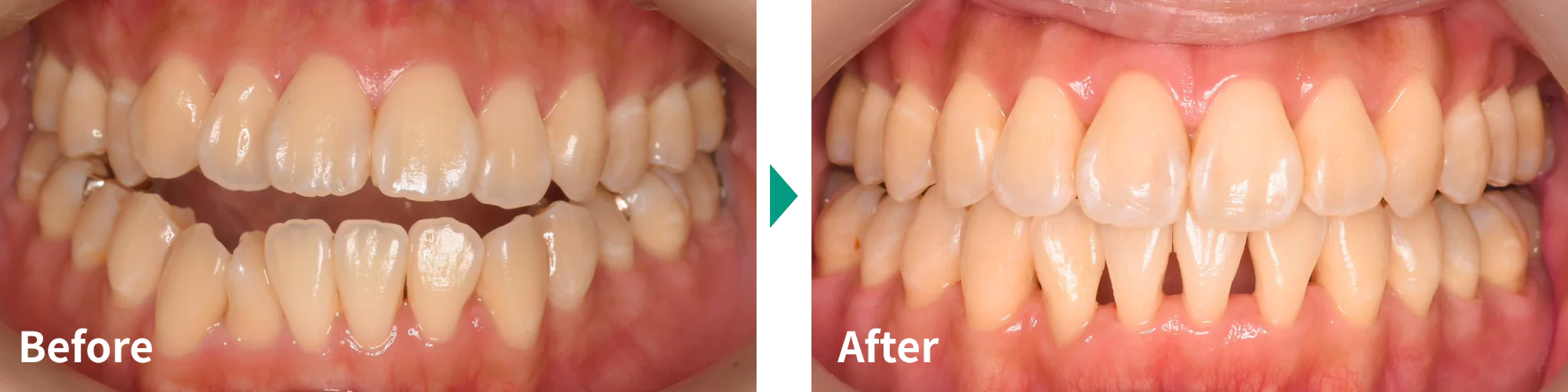マウスピース矯正（インビザライン）症例写真03｜山手歯科クリニック大井町