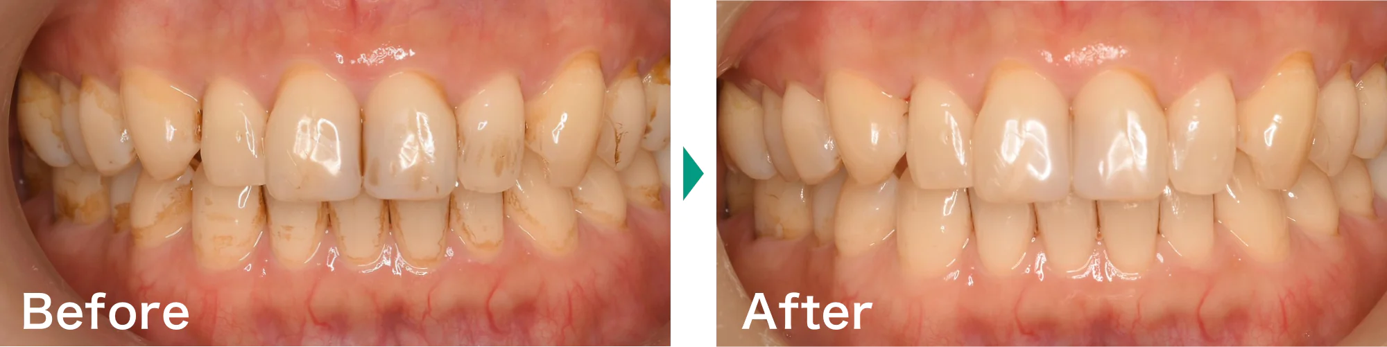 PMTCクリーニング症例写真01｜山手歯科クリニック大井町