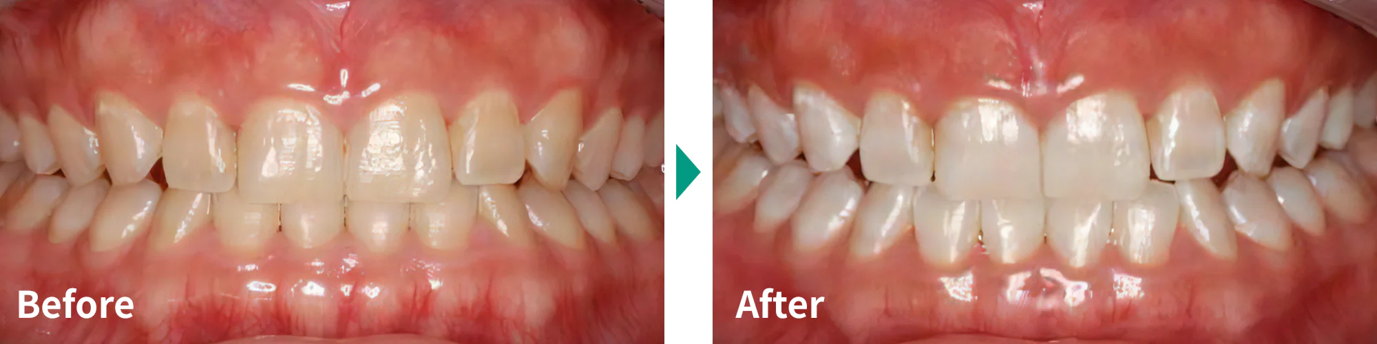 オフィスホワイトニング症例写真01｜山手歯科クリニック大井町