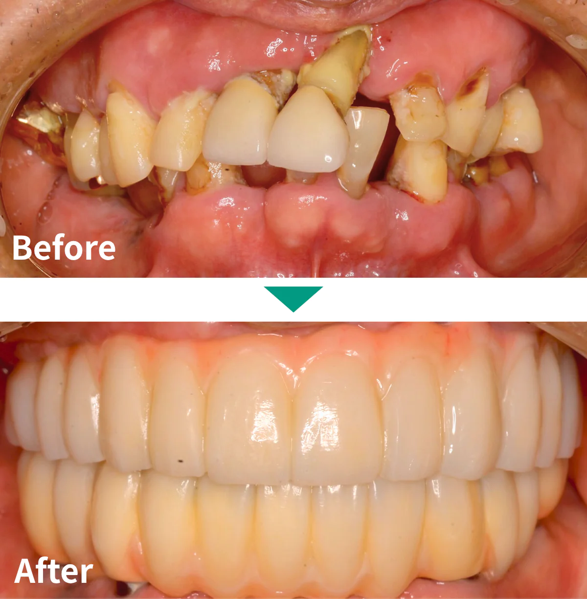 全顎インプラント治療症例写真02｜山手歯科クリニック大井町
