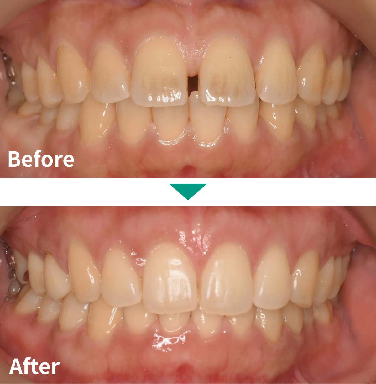マウスピース矯正（インビザライン）症例写真01｜山手歯科クリニック大井町