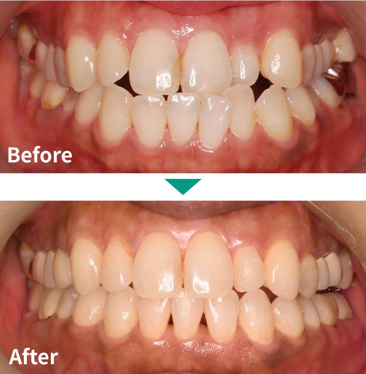 マウスピース矯正（インビザライン）症例写真02｜山手歯科クリニック大井町
