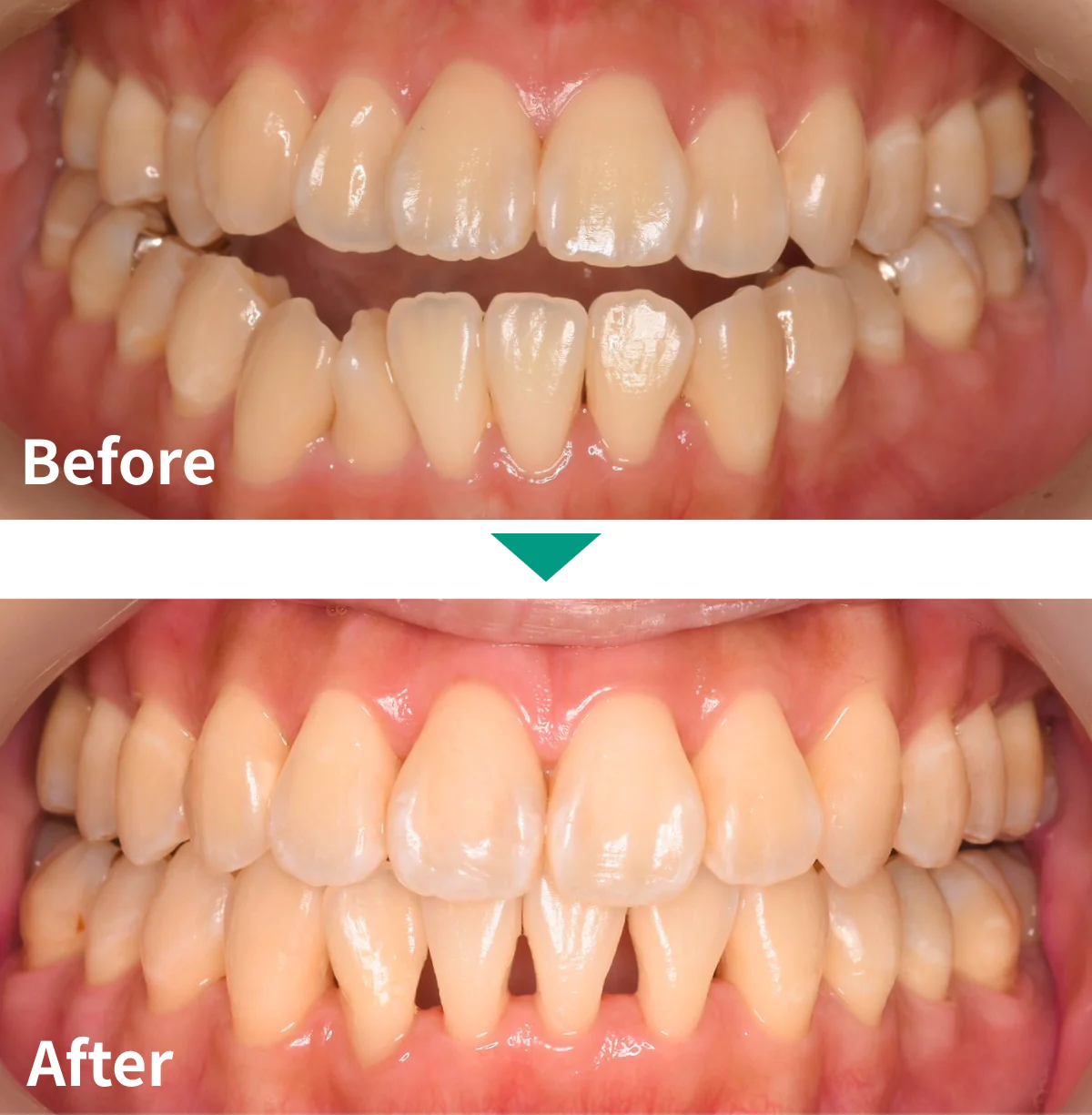 マウスピース矯正（インビザライン）症例写真03｜山手歯科クリニック大井町