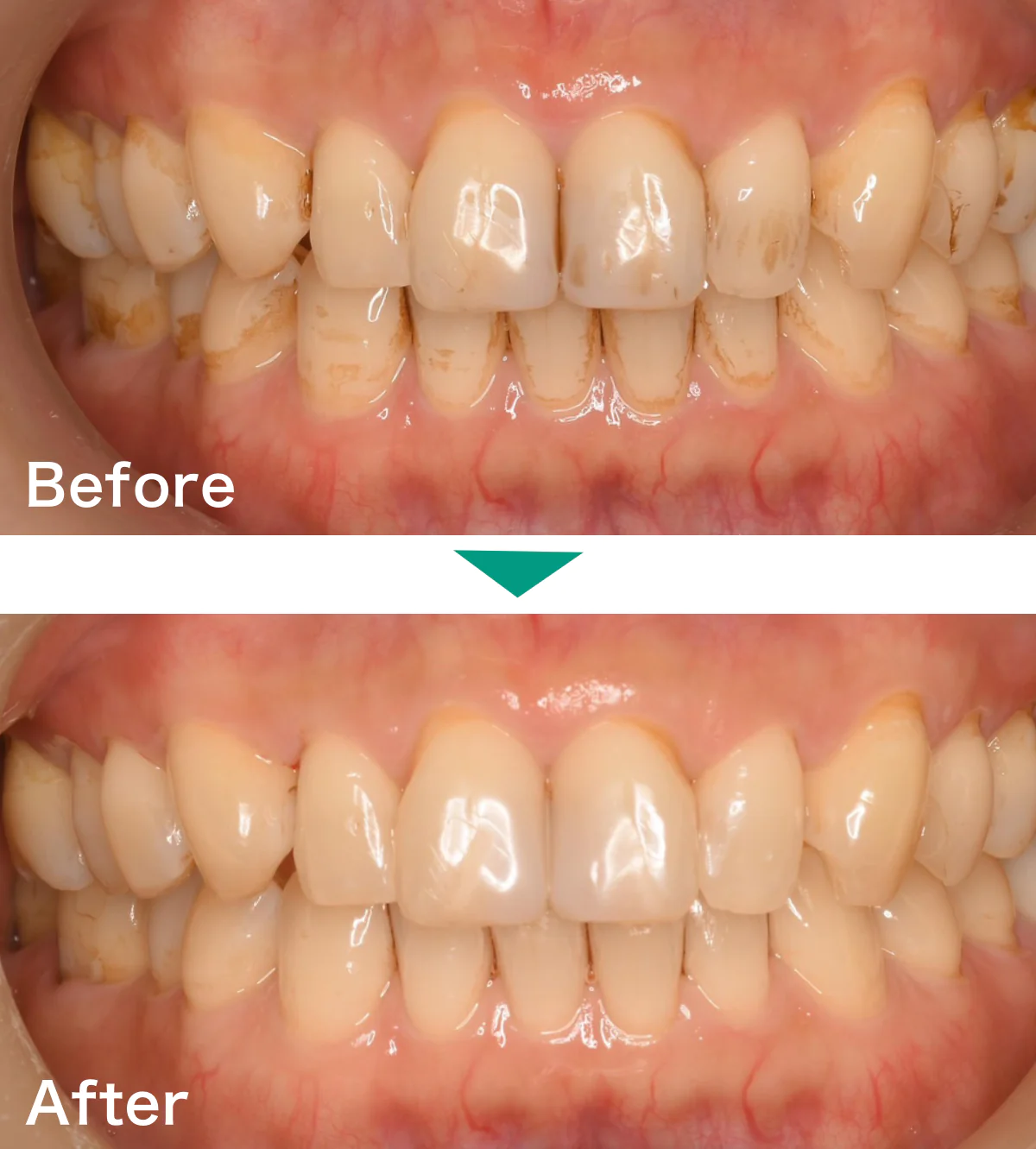PMTCクリーニング症例写真01｜山手歯科クリニック大井町