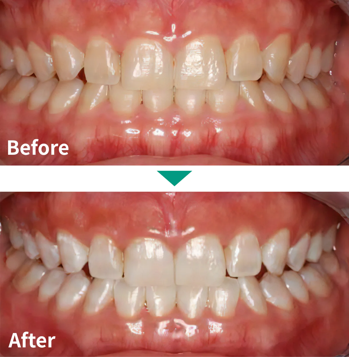 オフィスホワイトニング症例写真01｜山手歯科クリニック大井町