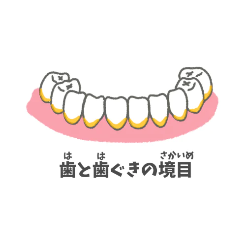 虫歯になりやすい部位｜歯と歯ぐきの境目