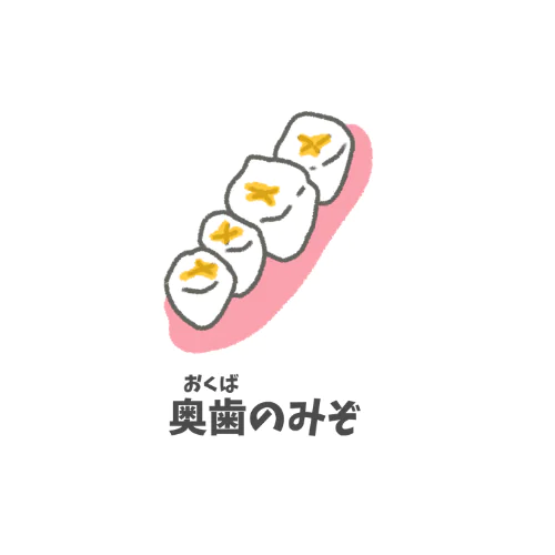 虫歯になりやすい部位｜奥歯の溝